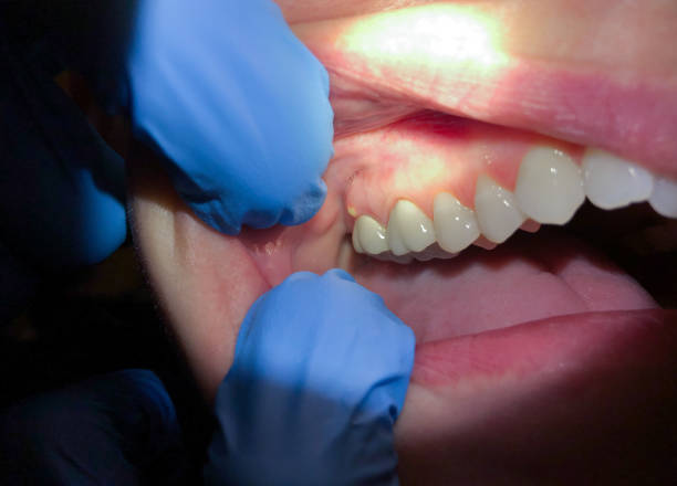 Best Emergency Treatment for Oral Infections in Gettysburg, SD