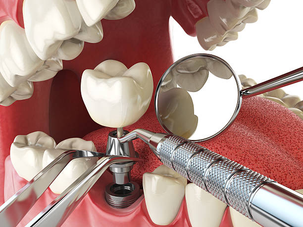 Best Lost Filling or Crown Replacement in Gettysburg, SD